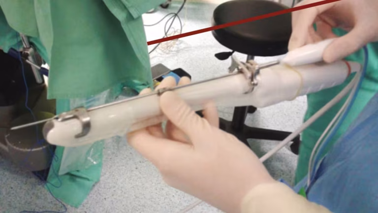 El Hospital de Gandia introduce una técnica pionera para tratar miomas uterinos sin cirugía invasiva